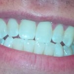 After-picture of my new smile. Lighting may exaggerate the extent of the improvement